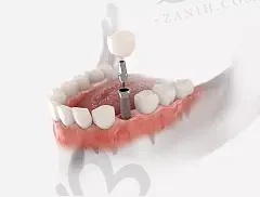 2023洛阳德国Camlog卡姆洛种植牙齿科医院口碑榜(洛阳拜博口腔医院享誉圈内)